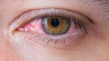 Опасен ли е кръвоизливът в окото?