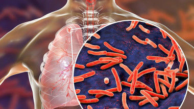 Д-р София Ангелова: Туберкулозата засяга хора със слаб имунитет