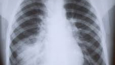 7 признака, че обикновена настинка е преминала в пневмония