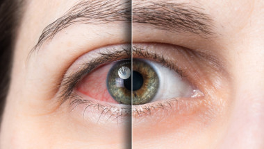 Кръвоизливът в окото налага да проверите състоянието на кръвоносните съдове