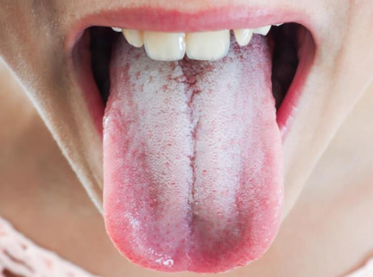 Какви заболявания може да откриете по езика си