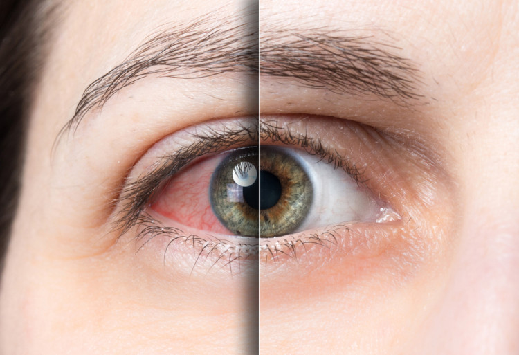Кръвоизливът в окото налага да проверите състоянието на кръвоносните съдове