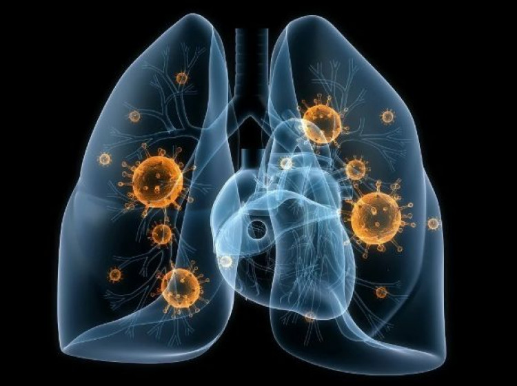 Как се лекува вирусна пневмония със забравени средства