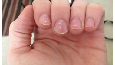 Какво означават белите петна по ноктите?