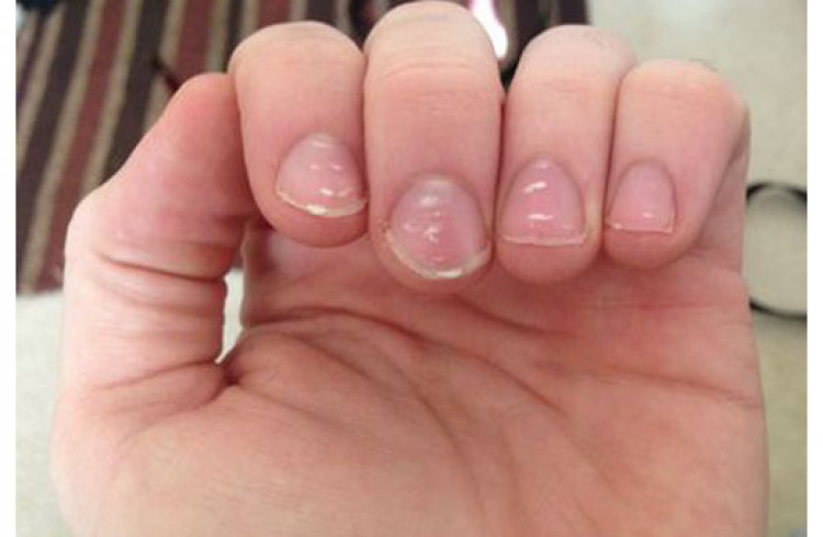 Какво означават белите петна по ноктите?