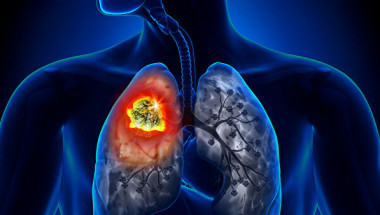 Комбинацията от 3 популярни лекарства помага за предотвратяване на рак на белия дроб 