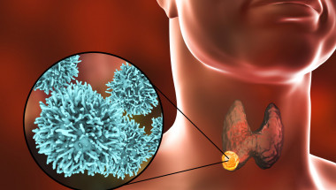 6 признака на рака  на щитовидната жлеза