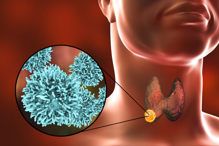 6 признака на рака  на щитовидната жлеза