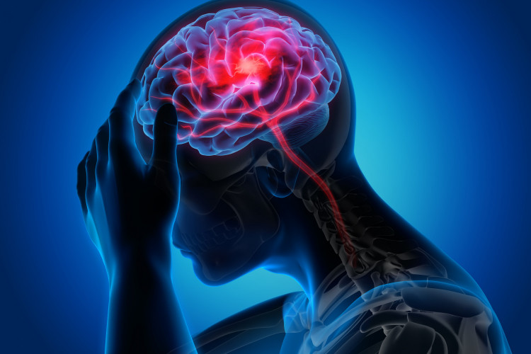 Често микроинсултът предшества същинския мозъчен удар