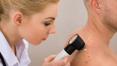 5 симптома на рак на кожата