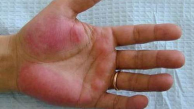 Червените длани са признак на страшна болест