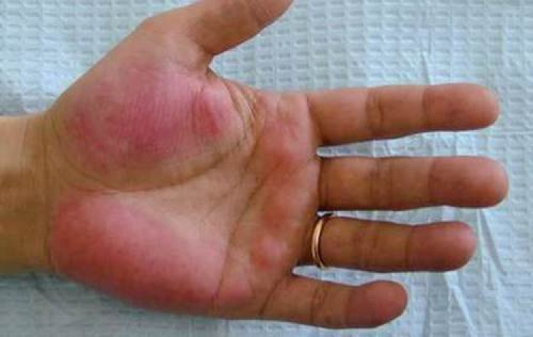 Червените длани са признак на страшна болест