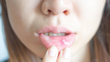 Ракът на устната кухина - как да го идентифицираме?