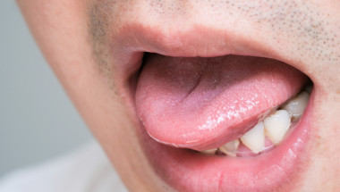 Необичайното „парене” по езика – симптом на множествена склероза