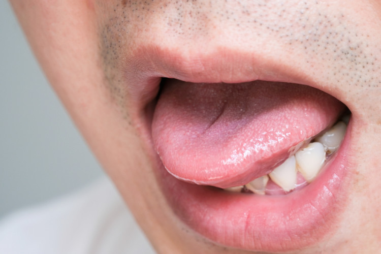 Необичайното „парене” по езика – симптом на множествена склероза