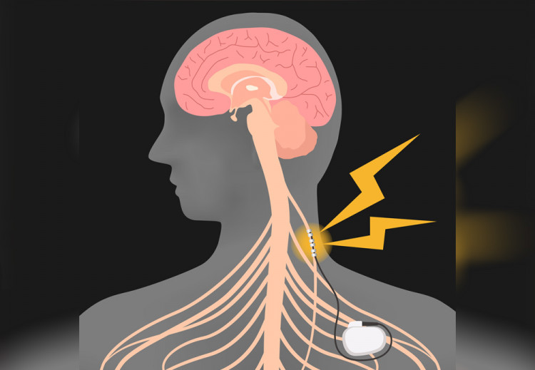 Веска Събева: Стимулацията на вагусовия нерв намалява епилептичните пристъпи