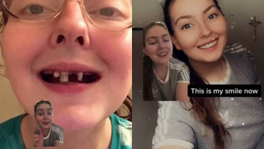 Момиче пиеше газирано в продължение на 10 години и това са зъбите й днес ВИДЕО