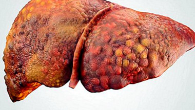 Как да разпознаем цироза на черния дроб