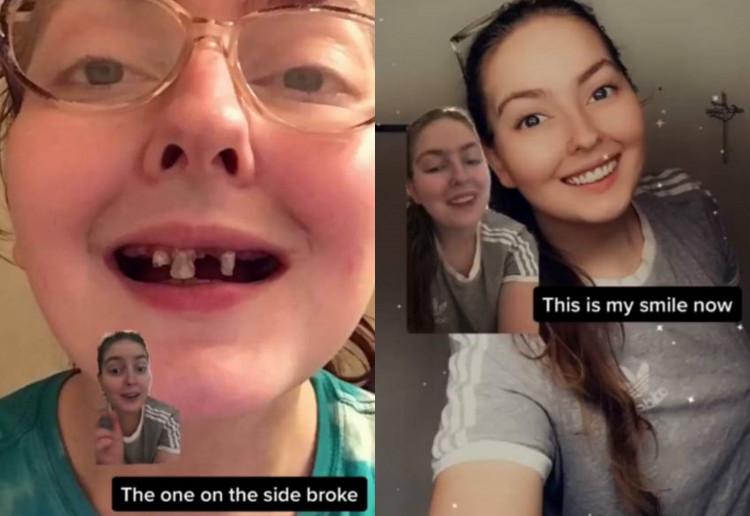 Момиче пиеше газирано в продължение на 10 години и това са зъбите й днес ВИДЕО