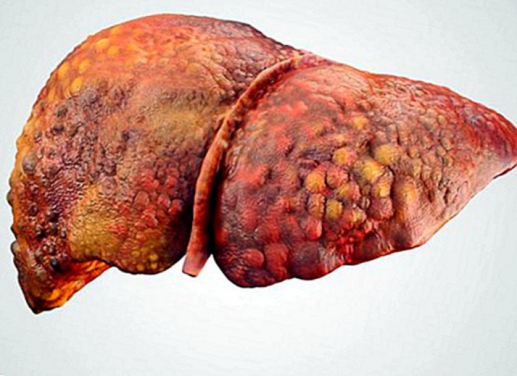 Как да разпознаем цироза на черния дроб
