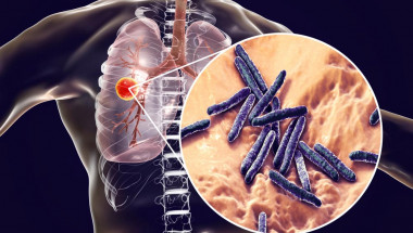 Д-р Лиляна Чунева: Туберкулозно болните с COVID са с 3 пъти по-голям риск от смърт