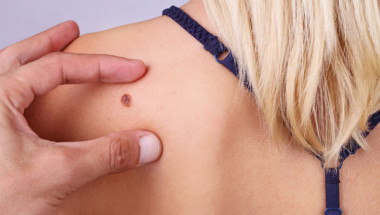 Рак на кожата: Как да разпознаем злокачествената бенка