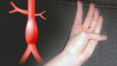 Разпознайте рано аортната аневризма по палеца