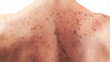 7 признака на рак на кожата, на които никой не обръща внимание