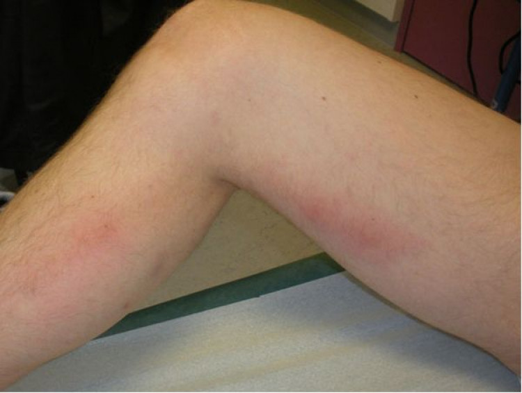 Дълбоката венозна тромбоза се проявява с определени признаци по краката