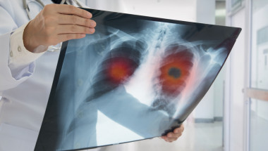 Проф. д-р Асен Дудов: Едномесечно забавяне при рак на белия дроб увеличава смъртността с 11%