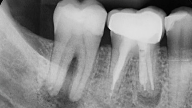 Колко рентгенови снимки на зъб са включени в едно направление?