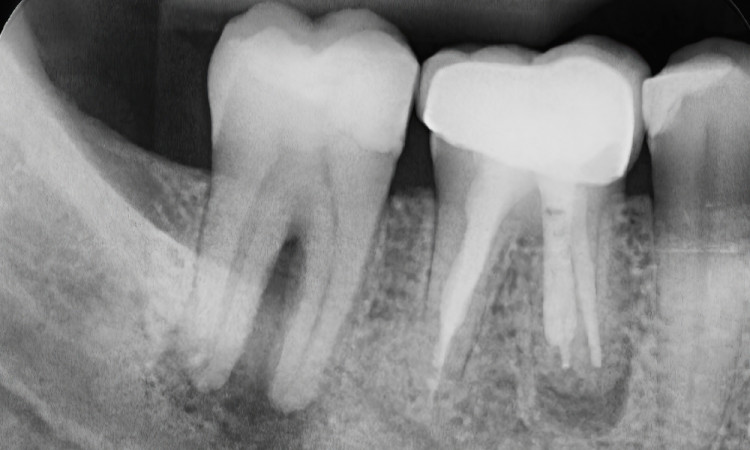 Колко рентгенови снимки на зъб са включени в едно направление?