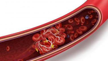 Лекар нарече основните 3 фактори за появата на кръвни съсиреци