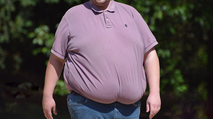 Д-р Спас Иванов: Болестното затлъстяване е епидемия