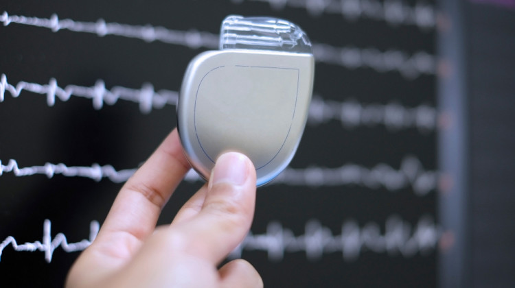 Д-р Михаил Протич: Устройства могат да нормализират сърдечния ритъм