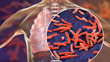 Д-р Веселин Давчев: Диабетът и ракът са рискови за развитието на туберкулоза