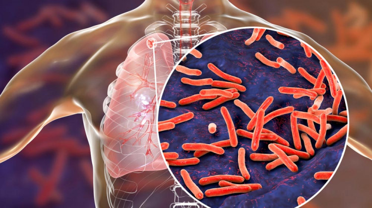 Д-р Веселин Давчев: Диабетът и ракът са рискови за развитието на туберкулоза