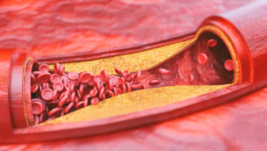 Атеросклерозата е възпалителен процес
