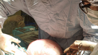 Пловдивски лекари отстраниха 7-кг. тумор от яйчника на пациентка СНИМКИ