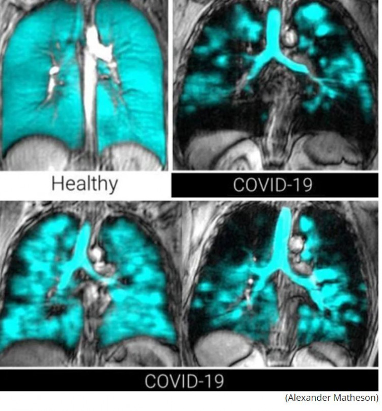 СНИМКА ясно показа източника на дълготраен Covid в белите дробове