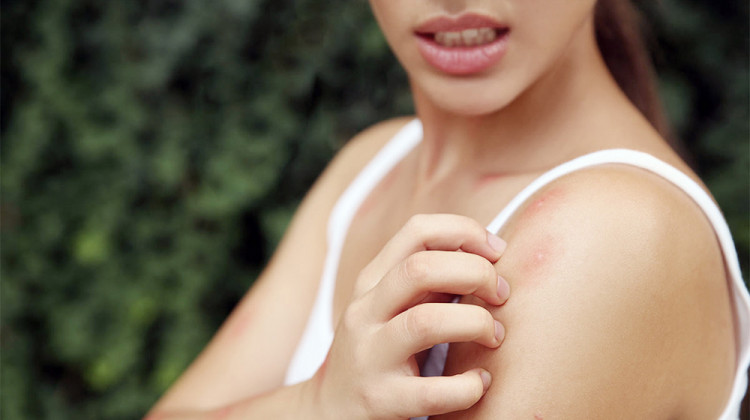 3 начина да се справим със сърбежа след ухапване от комар