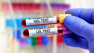 Високите нива на HDL холестерол се свързват с нисък риск от сърдечни заболявания