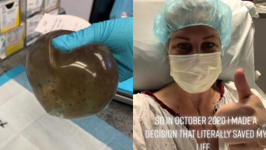 Жена откри мухъл в гръдните си импланти СНИМКА