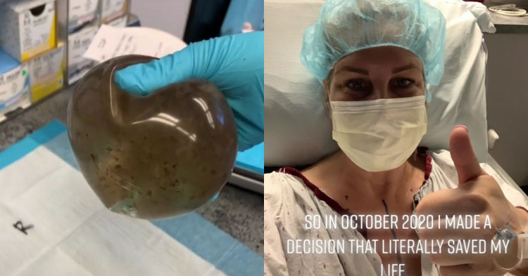 Жена откри мухъл в гръдните си импланти СНИМКА
