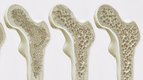 Д-р Родина Несторова: Профилактиката и лечението на остеопорозата продължават да се подценяват