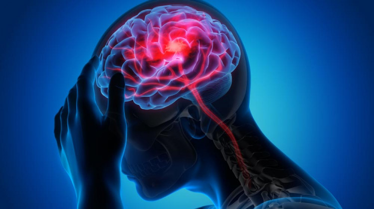 Пулсиращото главоболие - признак на мозъчна аневризма