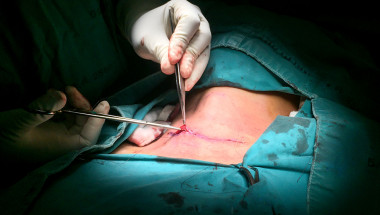 Операцията за отстраняване на щитовидната жлеза поема ли се от НЗОК?