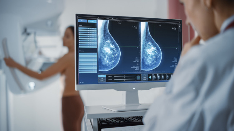 Имам ли право на мамография, ако съм на 30 години?