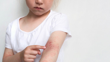 Д-р Деница Желева: Деца отключват псориазис  след стрептококова инфекция