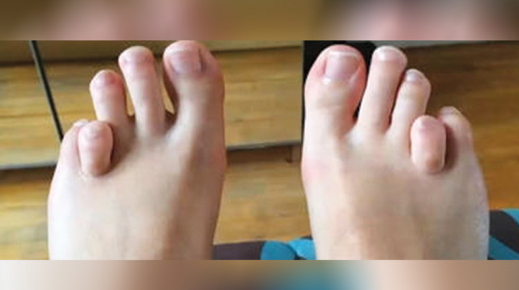 Д-р Димитър Стаматов: Има лечение при по-къс пръст на крака